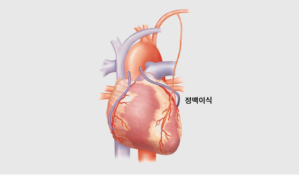 관상동맥우회술 이미지